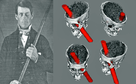 Phineas-Gage